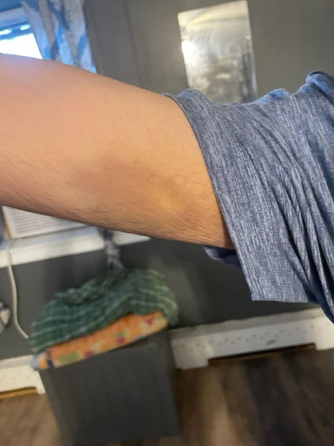 Aidan's arm bruise